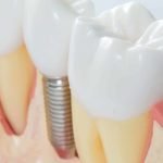 best dental implants in the world