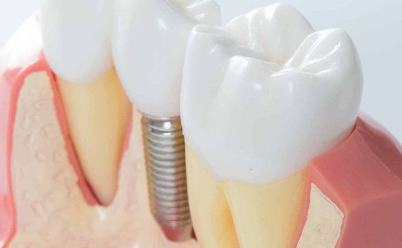 best dental implants in the world