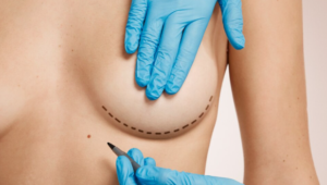 Breast Augmentation